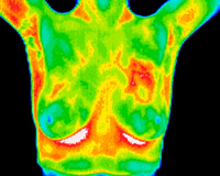 Breast Cancer Thermography