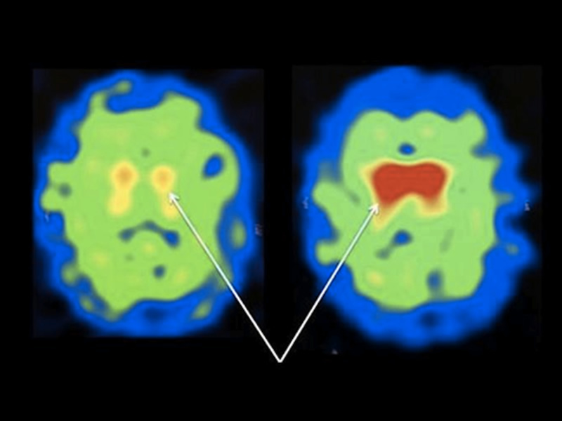 N-Acetyl Cysteine May Support Dopamine Neurons in Parkinson's Disease ...