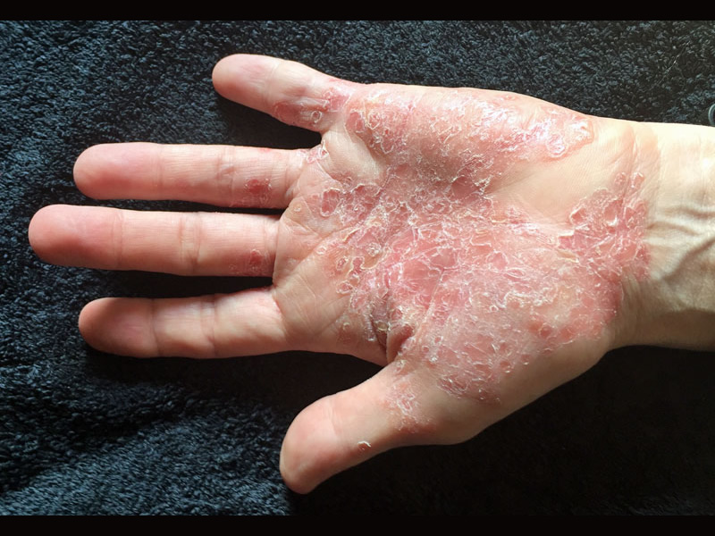 Psoriasis Packet 