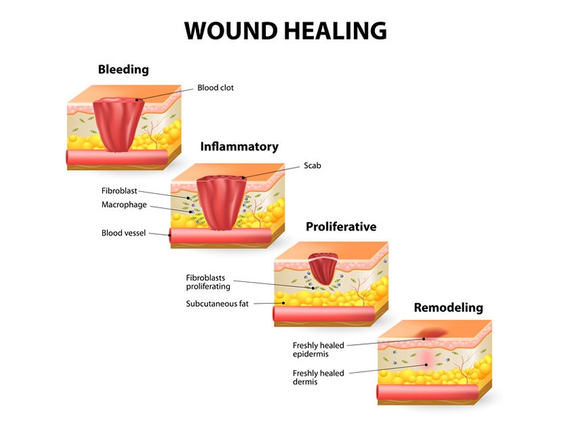 Illustration of phases of the wound healing process
