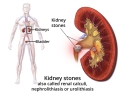 illustration of human body showing location of kidneys and bladder and enlargement of kidney showing stones
